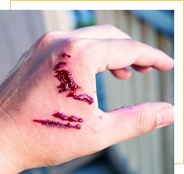 Focus dog bite wound and blood on hand